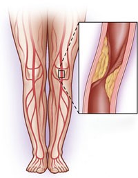 enfermedad-vascular-periferica